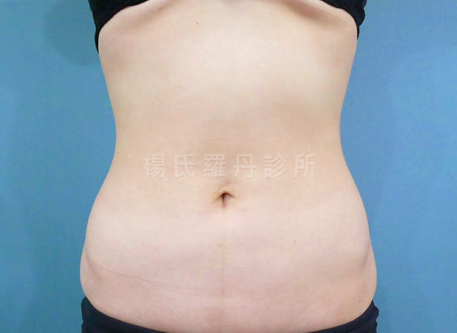 腹部抽脂 瘦肚子