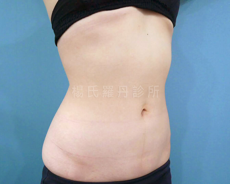 腹部抽脂 雷射減脂