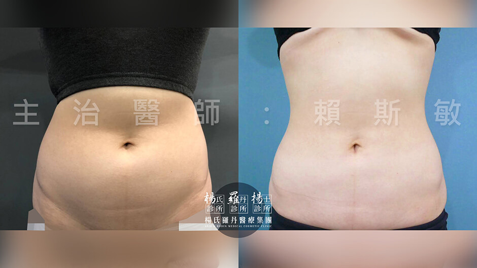 腹部抽脂 腹部環抽