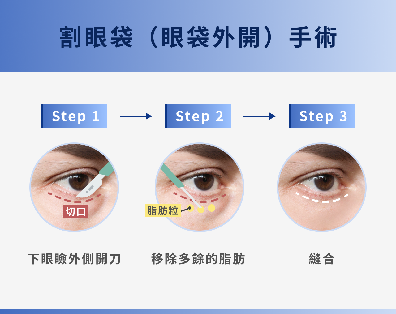 割眼袋（眼袋外開）手術