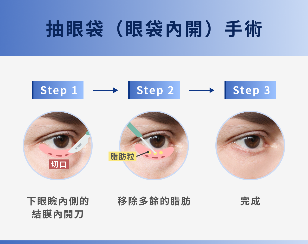 抽眼袋（眼袋內開）手術