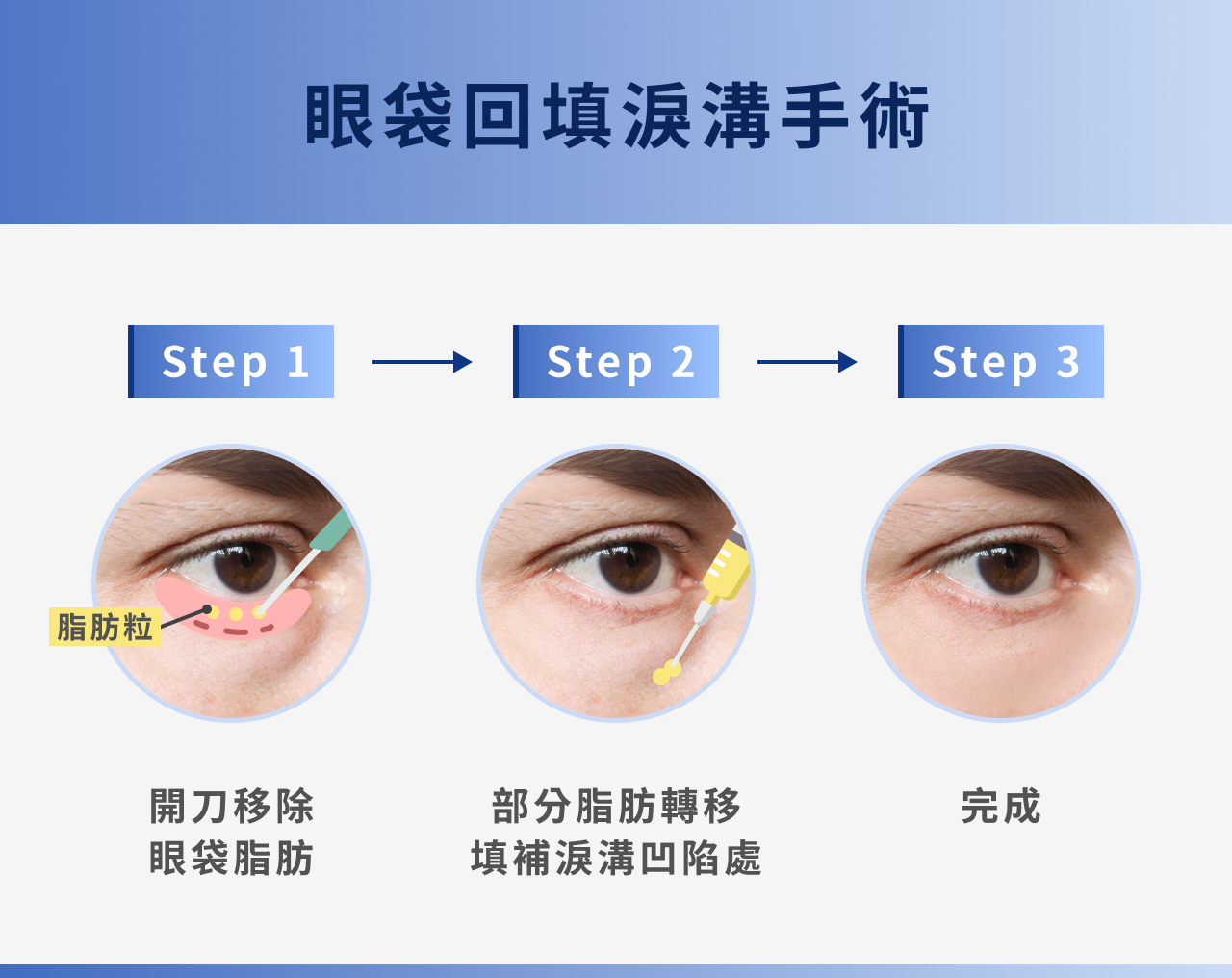 眼袋回填淚溝手術