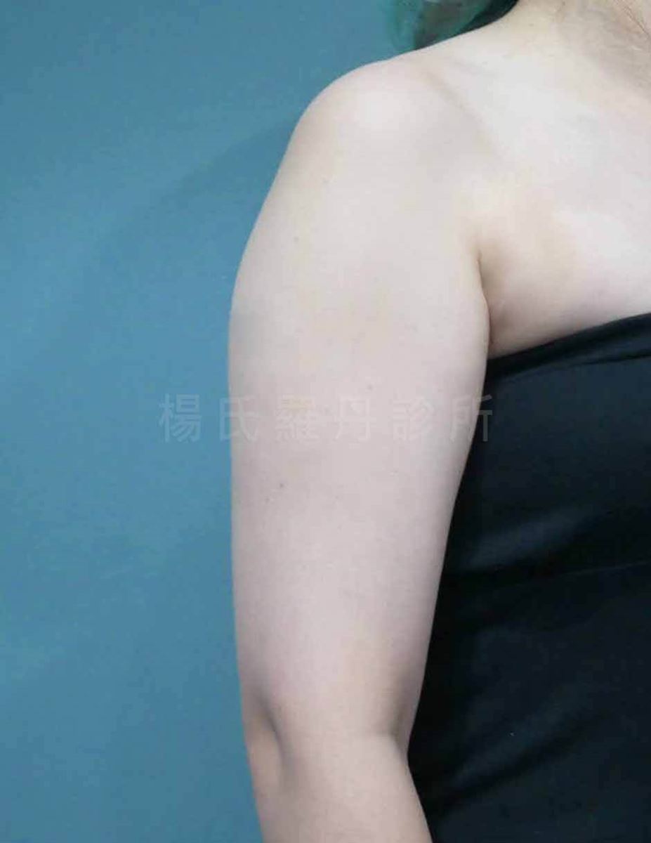 手臂抽脂 抽脂