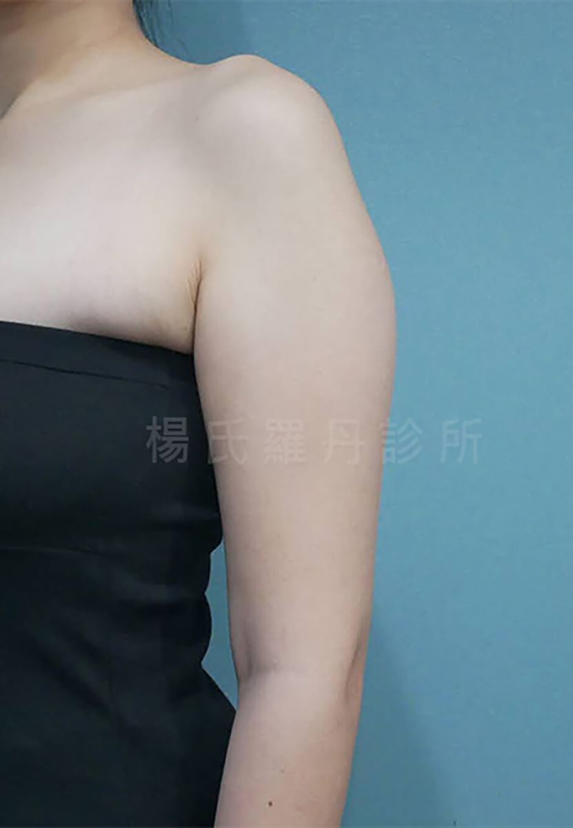 手臂抽脂 抽脂