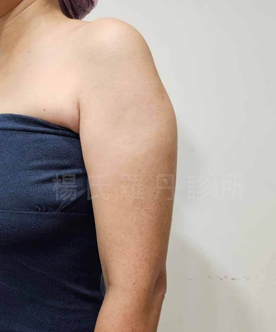 手臂抽脂 抽脂