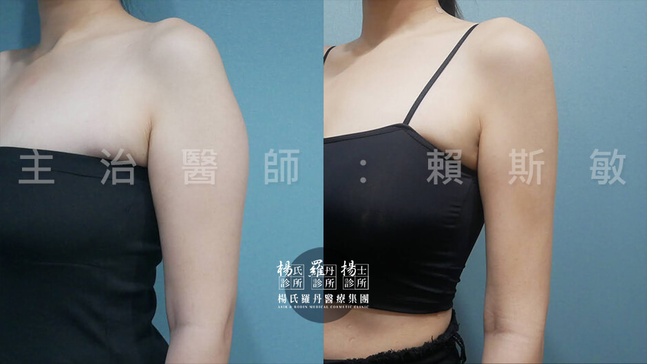 手臂抽脂 雷射減脂 減脂手術