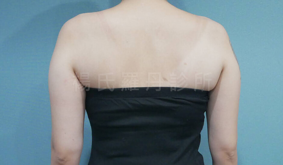 手臂抽脂 雷射減脂