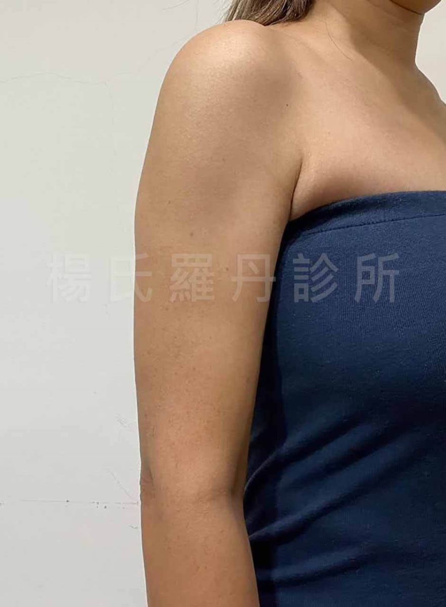 手臂抽脂 瘦手臂