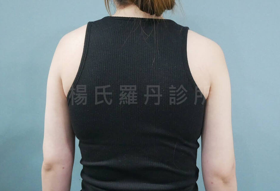 手臂抽脂 減脂手術