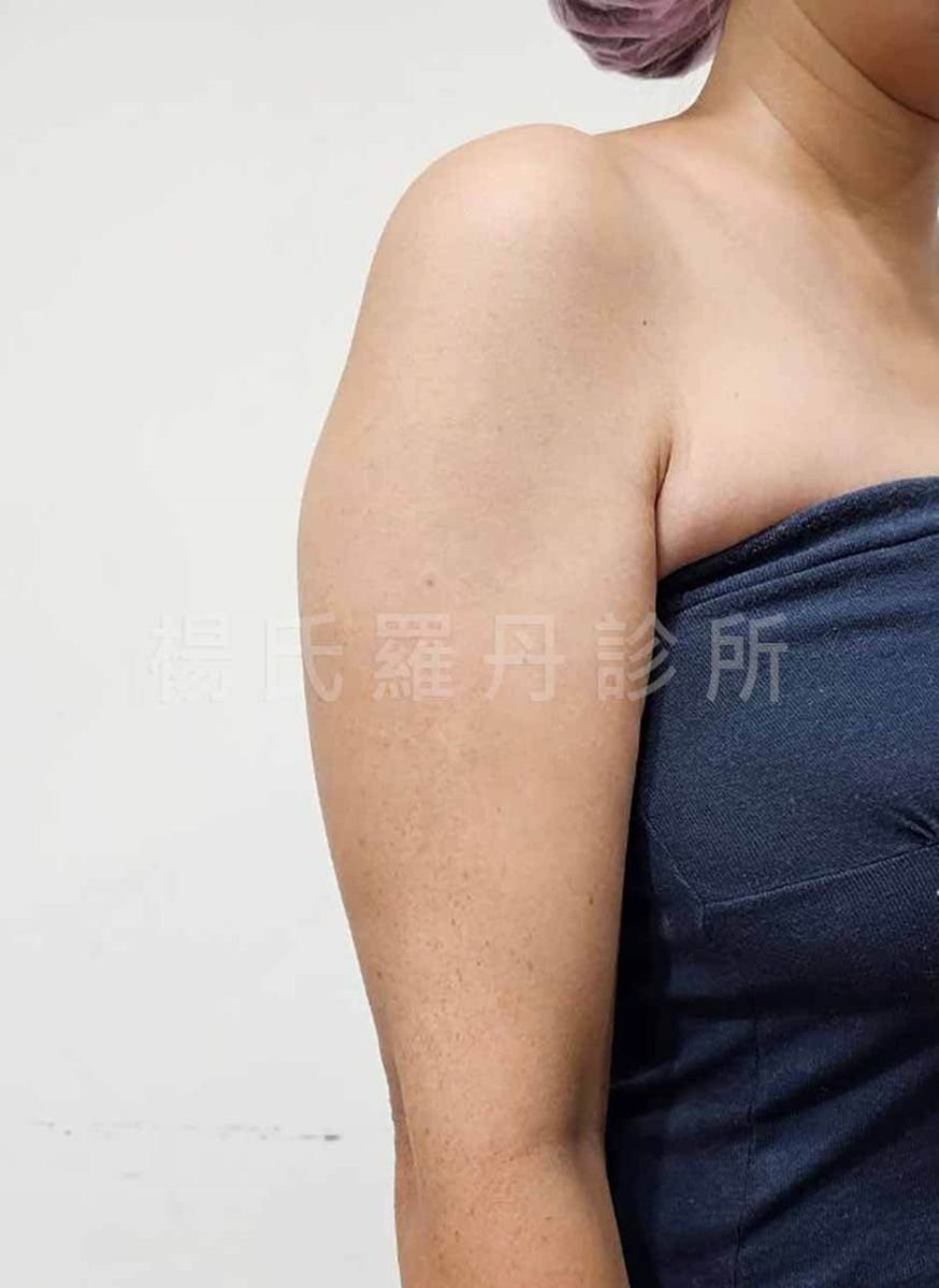 手臂抽脂 掰掰袖