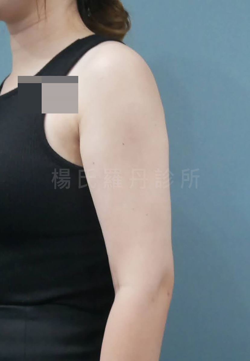 手臂抽脂 瘦手臂