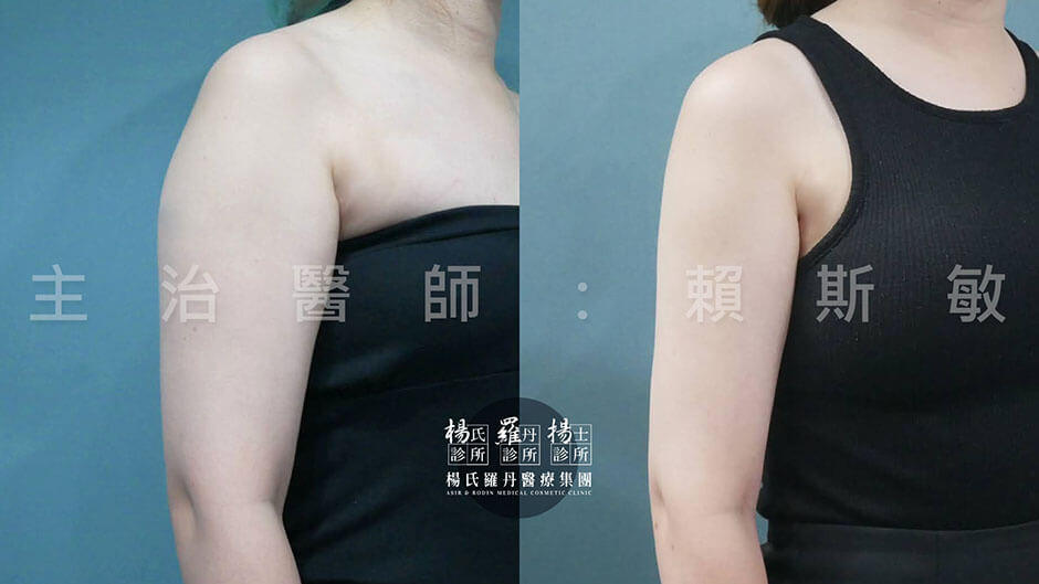 手臂抽脂 雷射減脂 抽脂