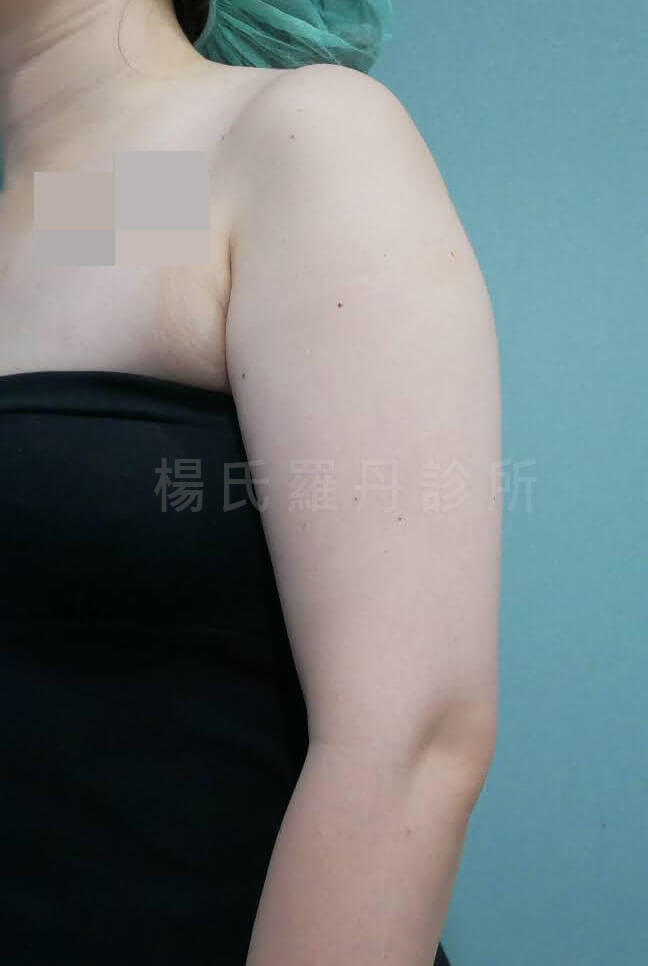 手臂抽脂 蝴蝶袖