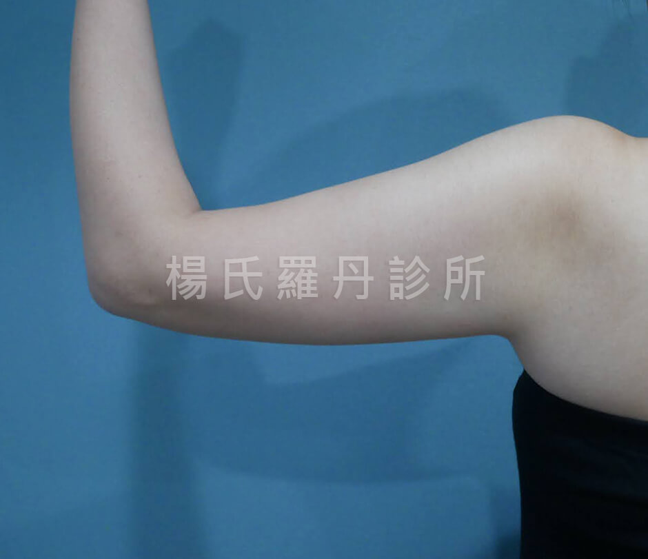 手臂抽脂 瘦手臂