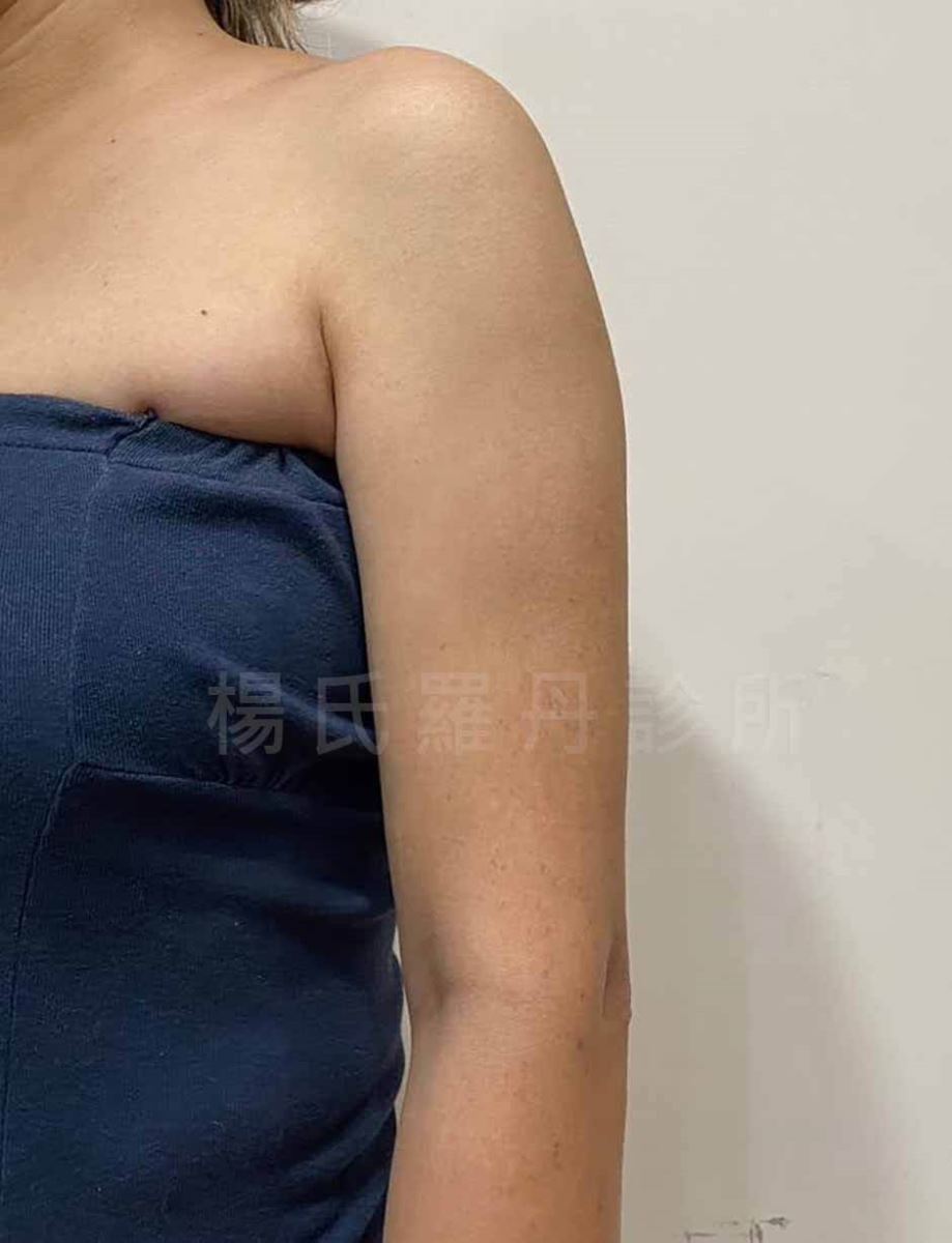 手臂抽脂 雷射溶脂