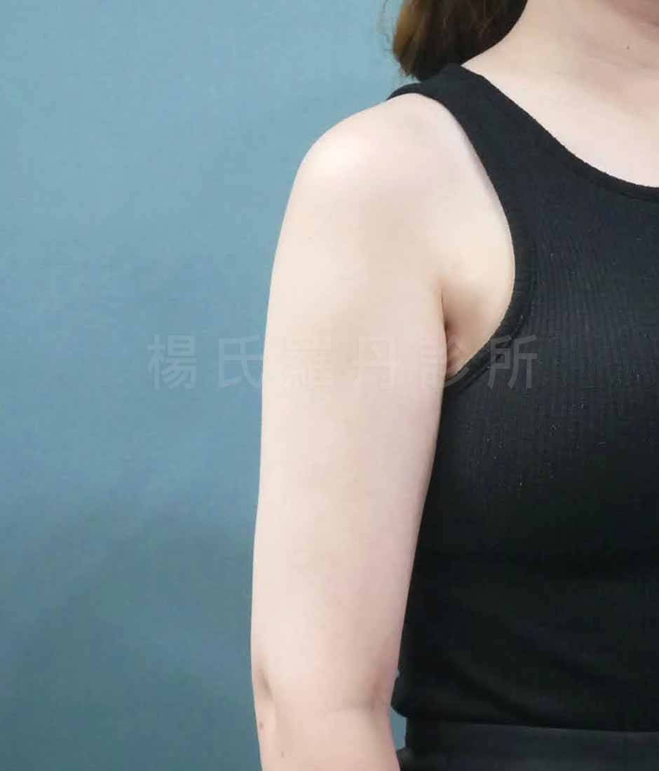 手臂抽脂 雷射溶脂