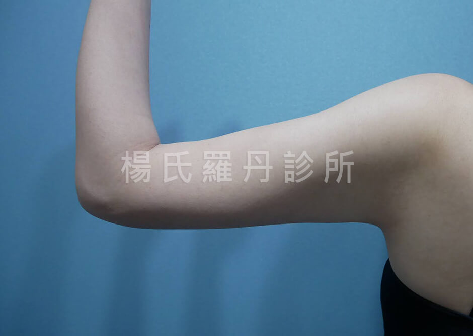 手臂抽脂 蝴蝶袖