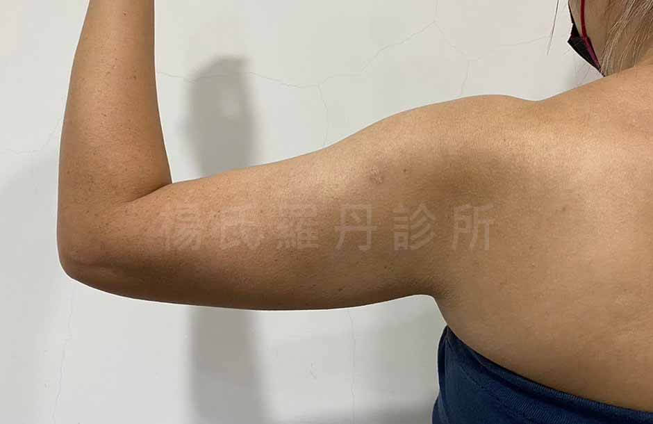 手臂抽脂 減脂 減脂手術