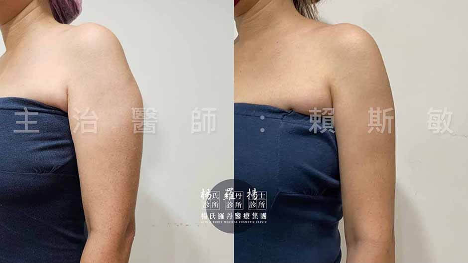 手臂抽脂 楊氏抽脂 雷射減脂