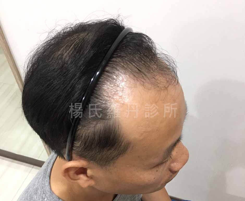 植髮 掉髮