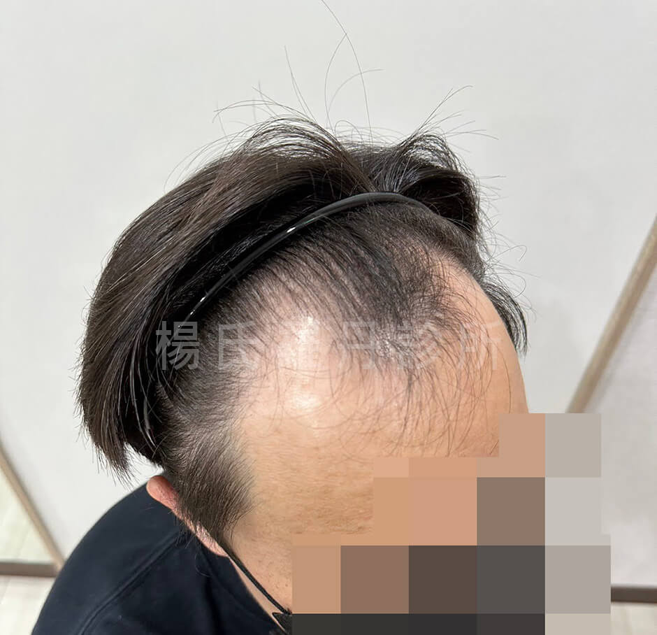 植髮 植髮成果