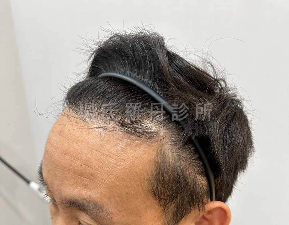 植髮 髮際線植髮