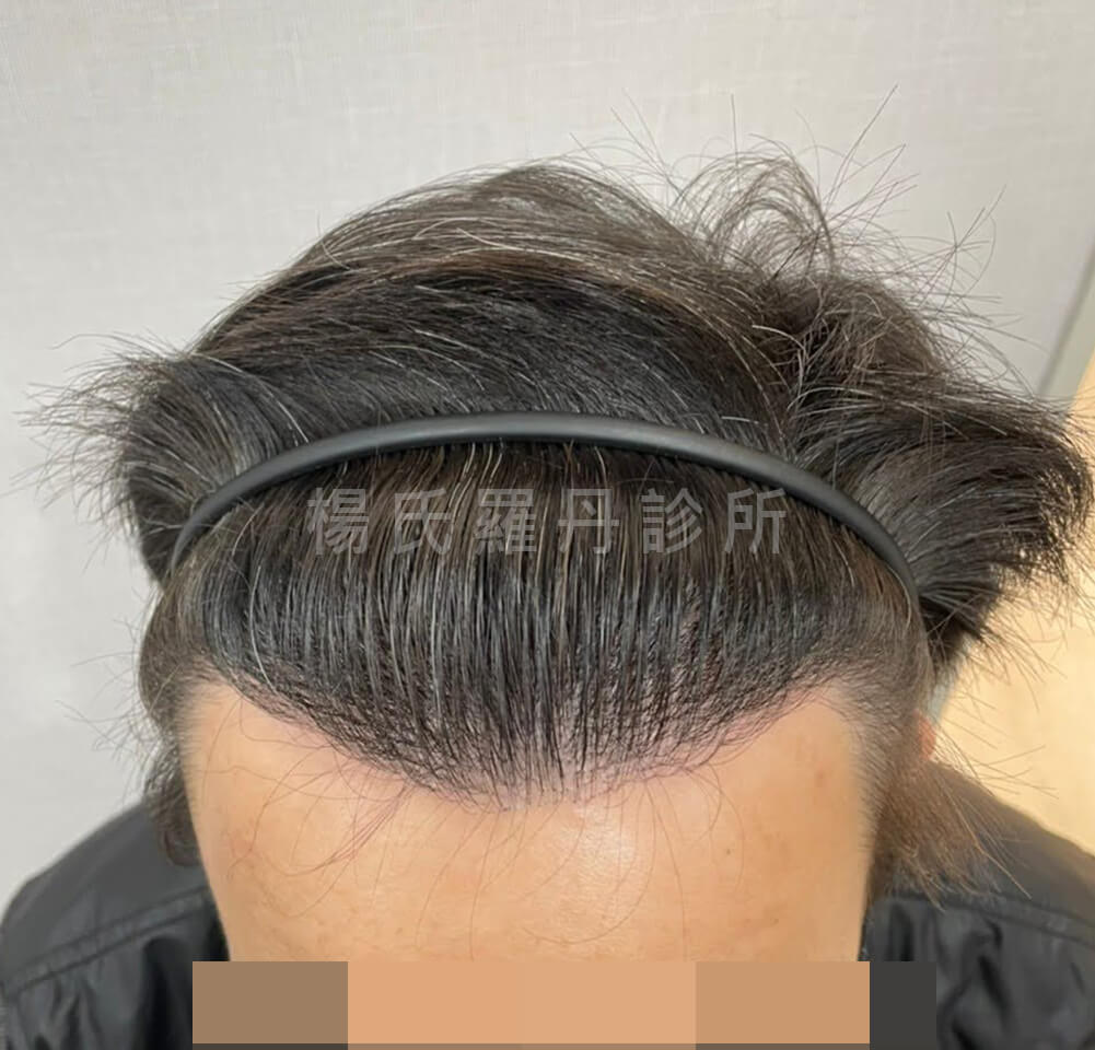植髮 植髮手術