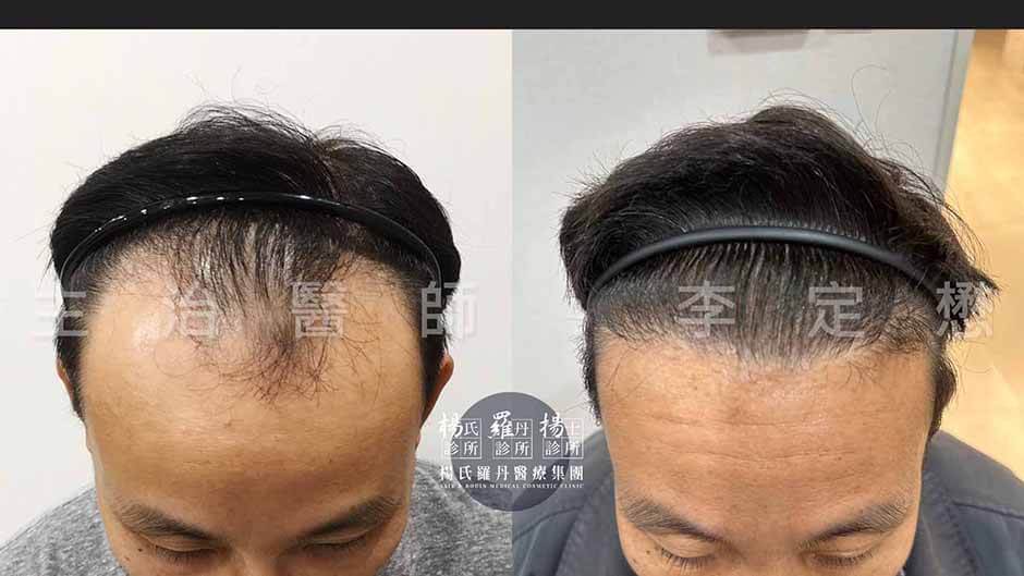 植髮 楊氏羅丹 髮際線