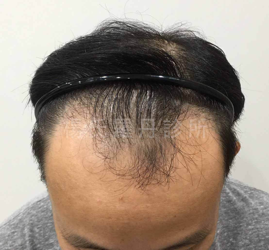 植髮 髮際線