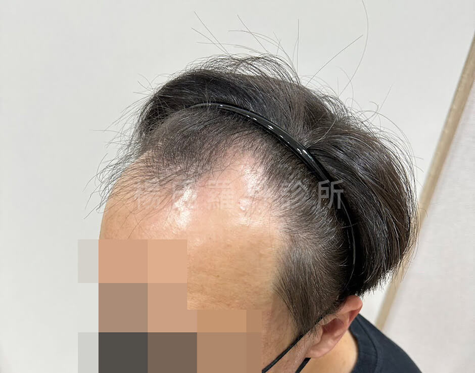 植髮 髮際線