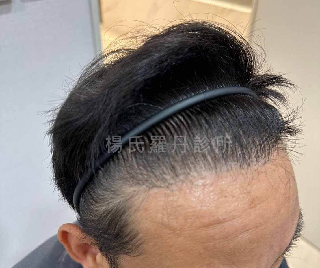 植髮 植髮效果