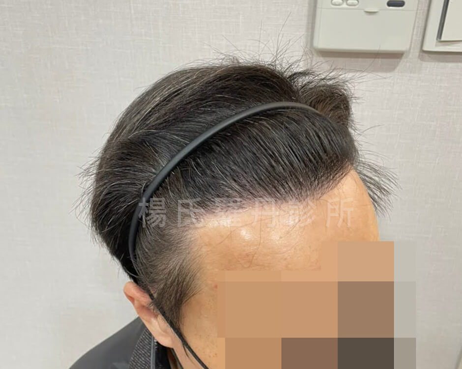 植髮 禿髮