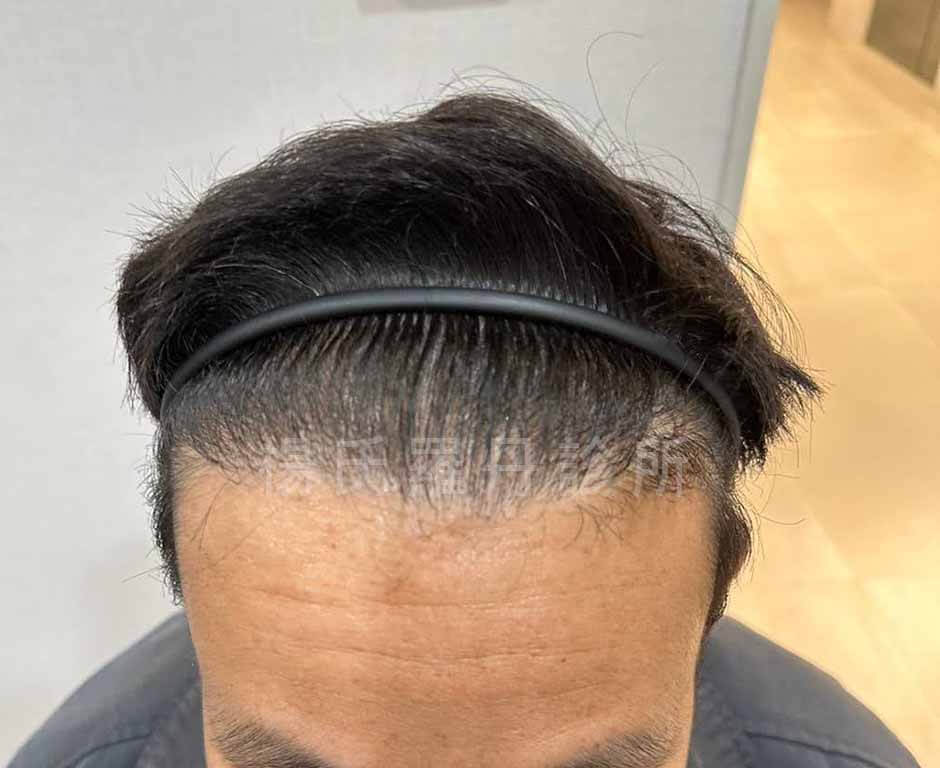 植髮 禿頭