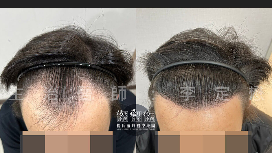 植髮 髮際線植髮 楊氏羅丹