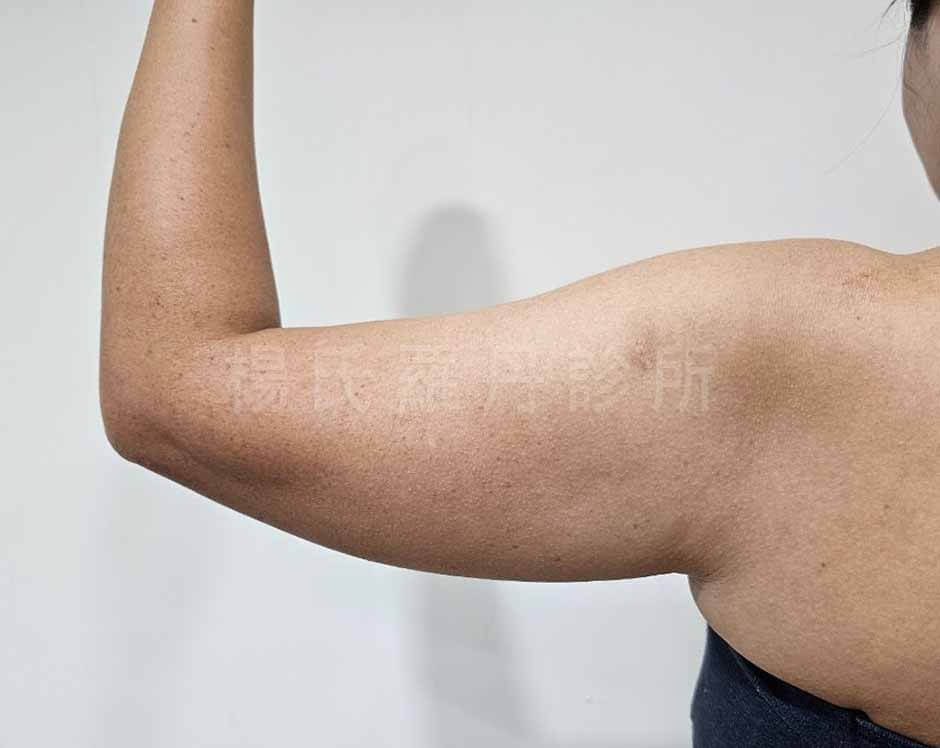 手臂抽脂 雷射減脂
