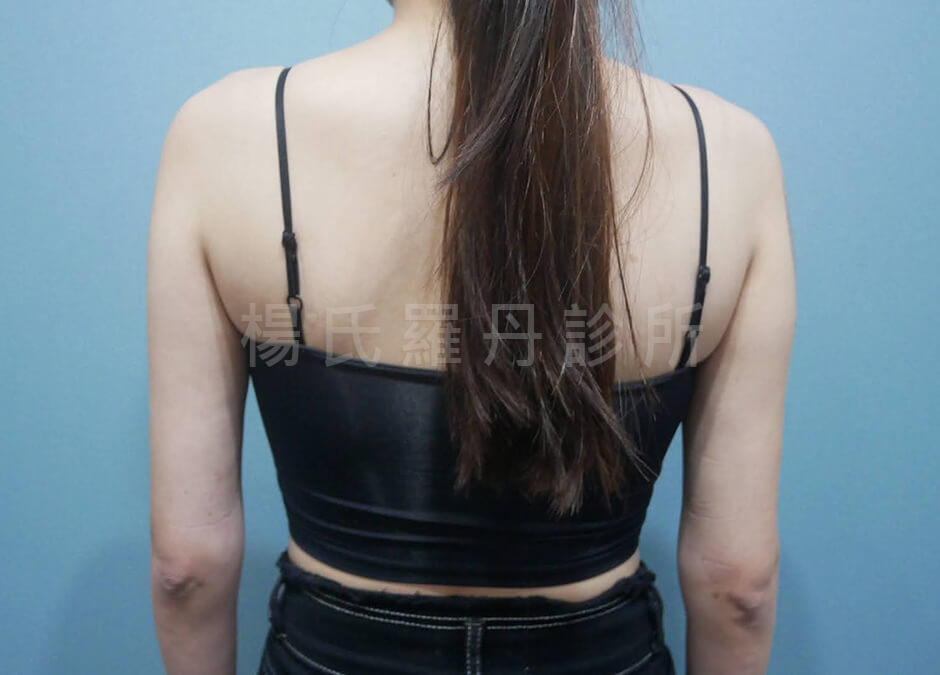 手臂抽脂 減脂 雕塑