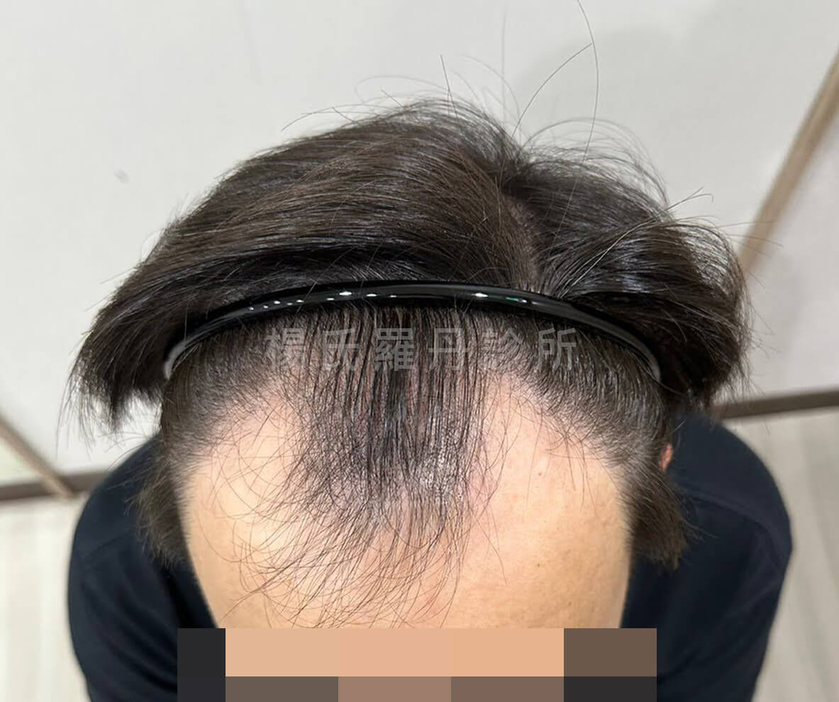 植髮 髮際線植髮