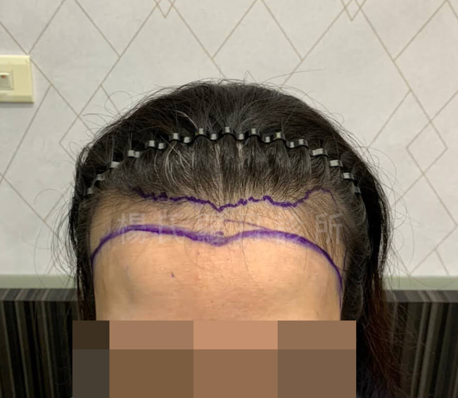 植髮 女性植髮