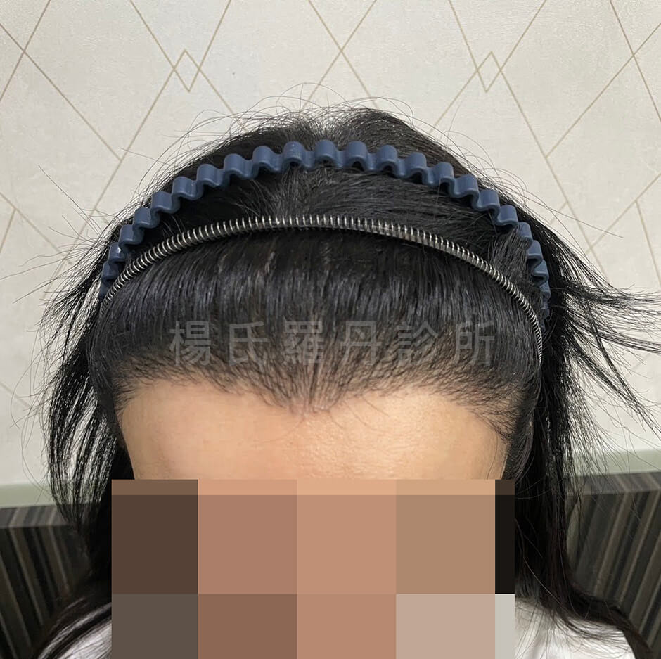 女性髮際線 植髮