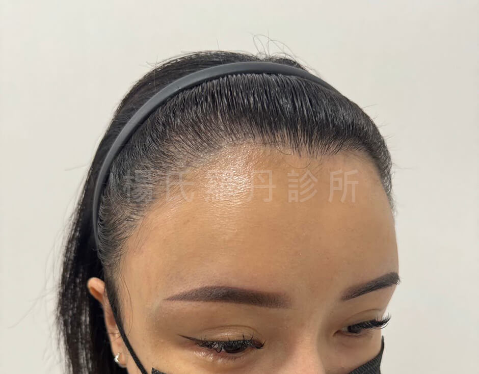 女性植髮 髮際線