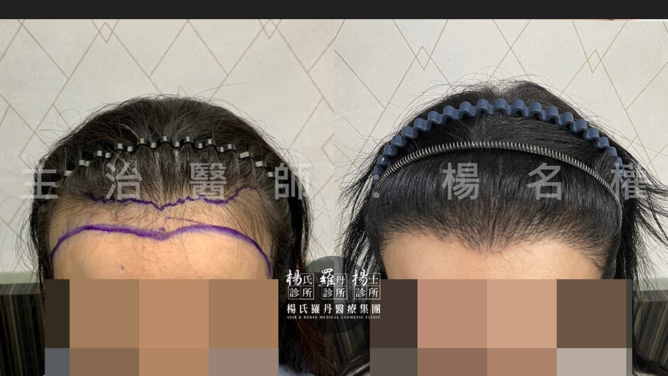 女性髮際線 植髮 植髮案例
