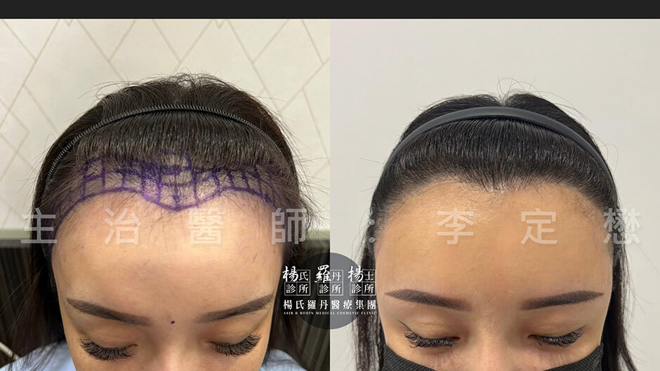 女性植髮 女性髮際線 植髮