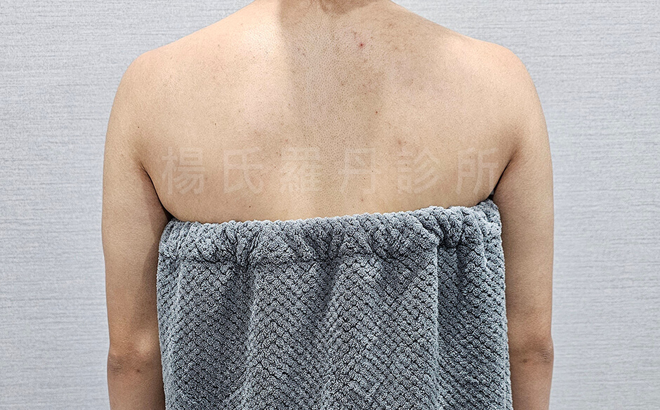 雷射減脂 減脂手術