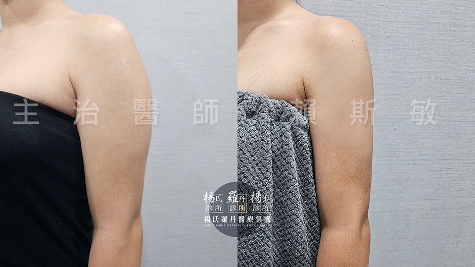 手臂抽脂 抽脂 雷射減脂