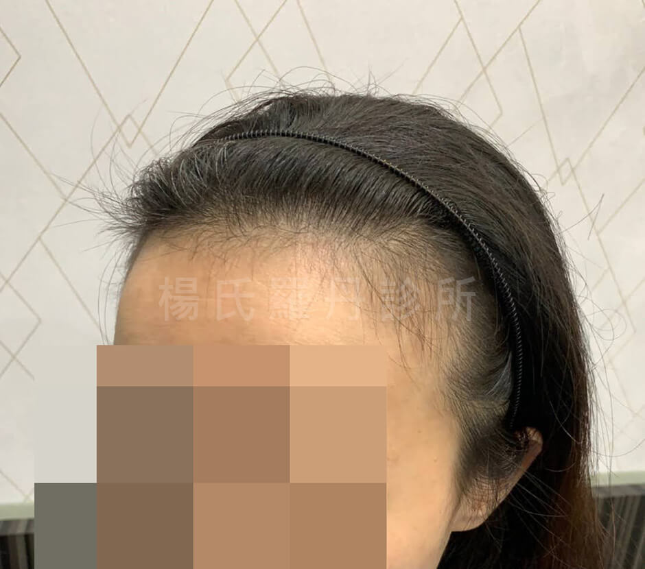 植髮 植髮手術