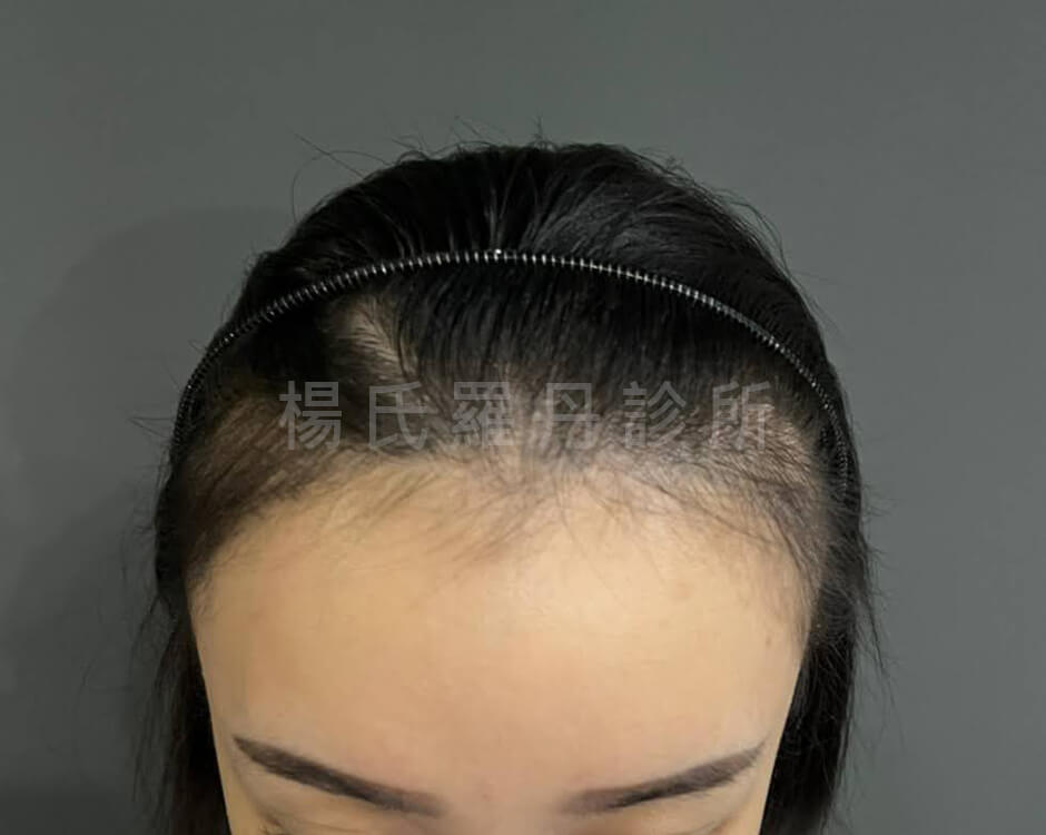女性髮際線 植髮