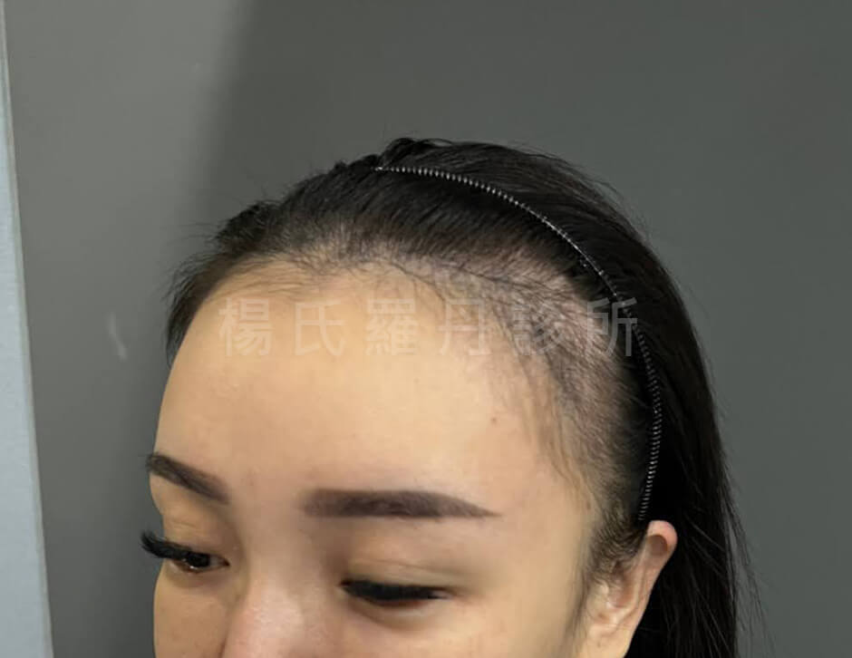 植髮 女性植髮