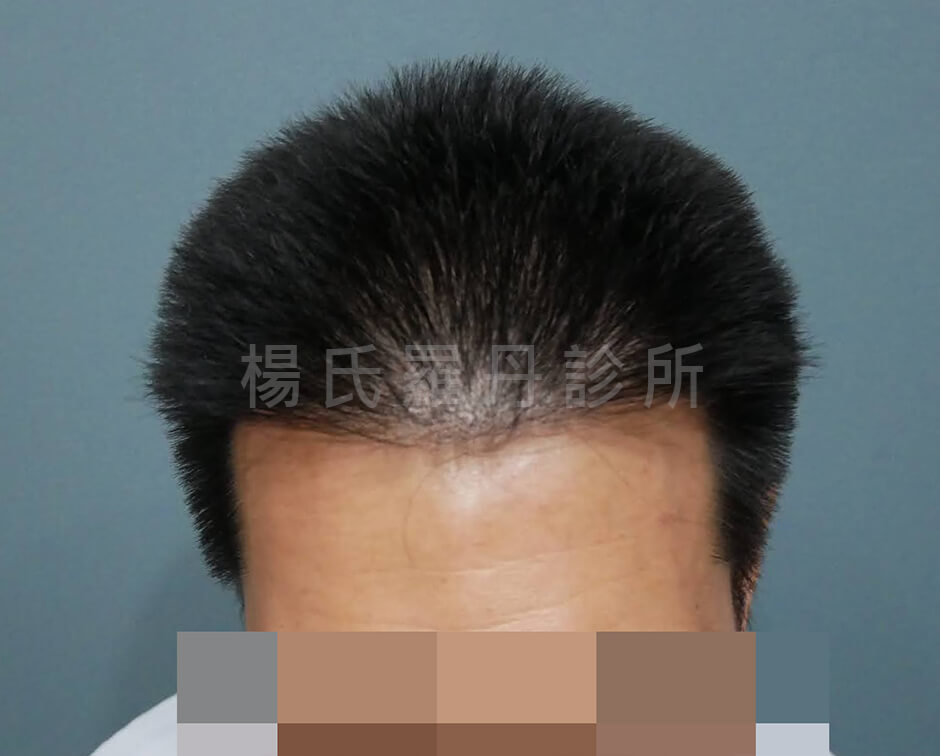 植髮 微創植髮