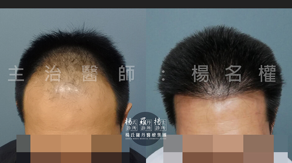 植髮 微創植髮 楊氏羅丹