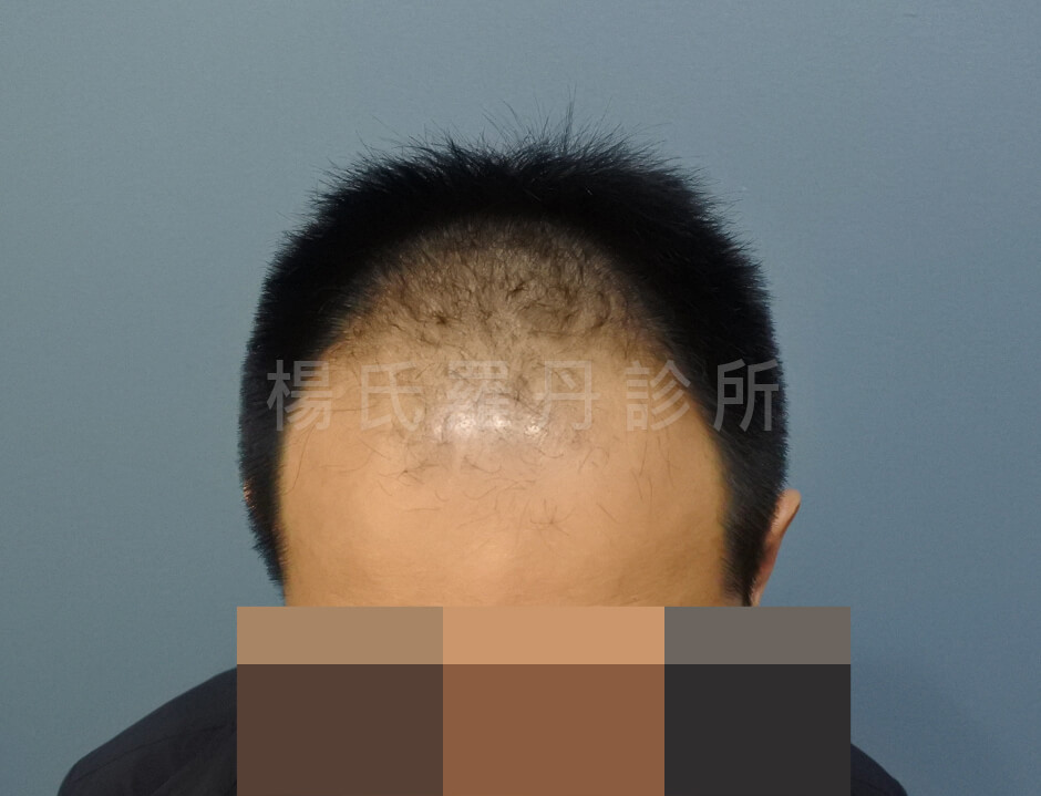 植髮 禿頭